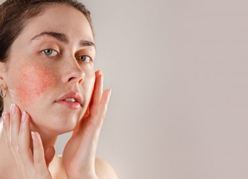 Photo of a woman with rosacea redness on her cheek