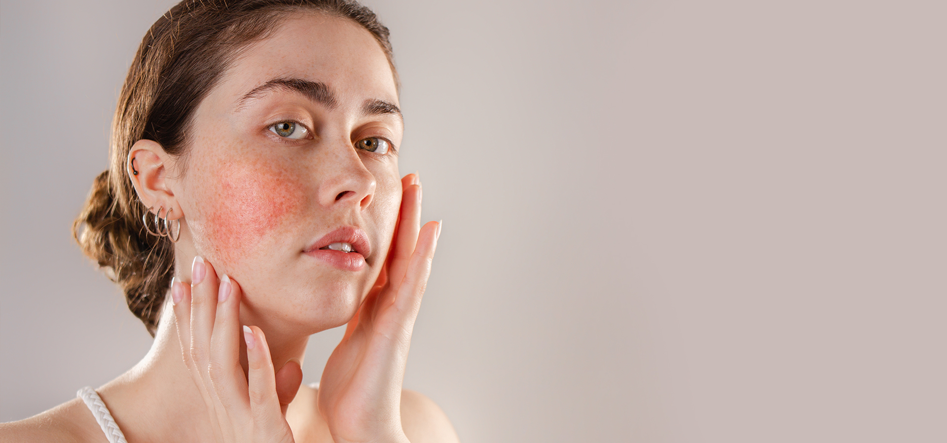 Rosacea