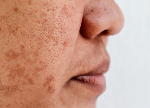 Photo of sun damage on a woman's face