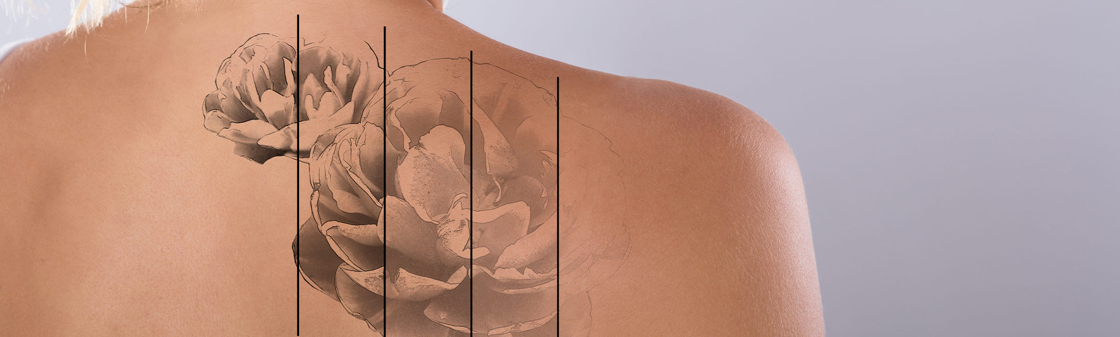 Laser Tattoo Removal – Coming Soon