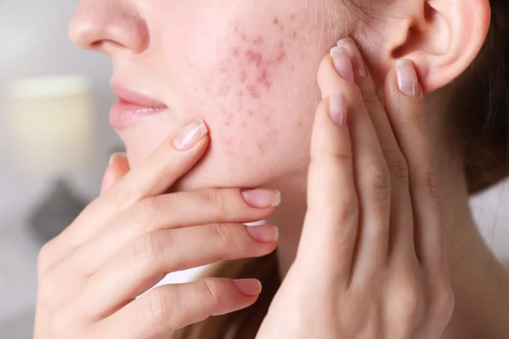 Close-up of a woman's cheek showing red spots and uneven skin texture as she touches her face.