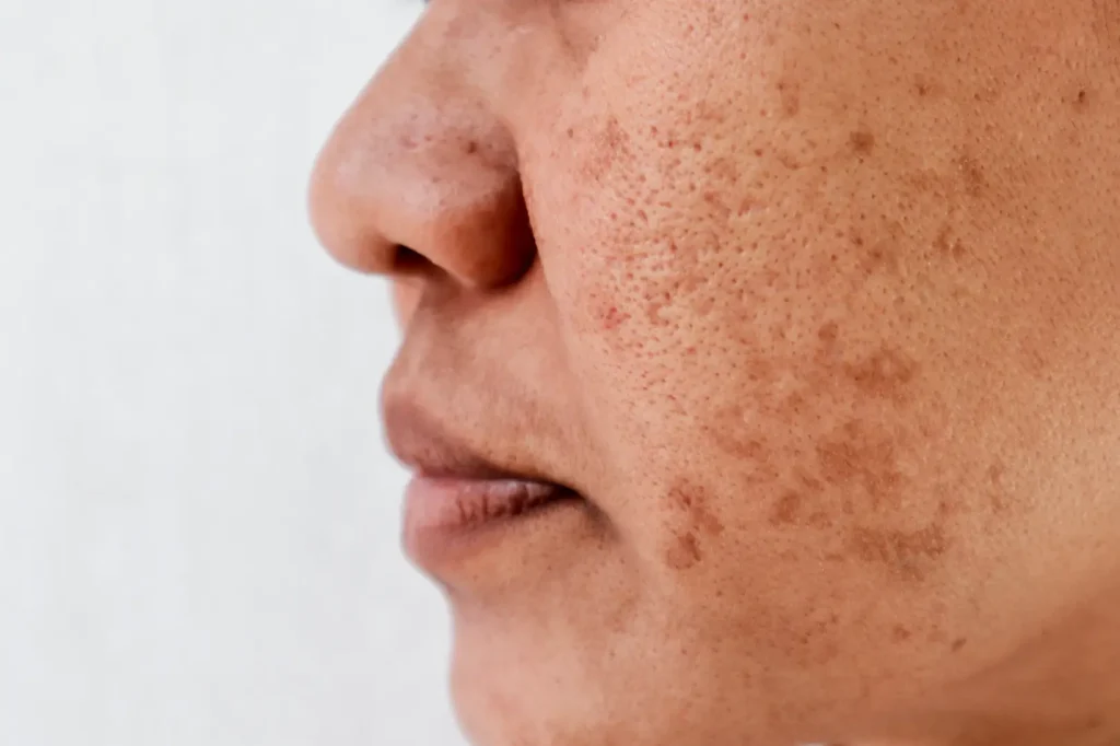Close-up side view of a cheek with visible pores, uneven texture, dark spots, and indented acne scars.