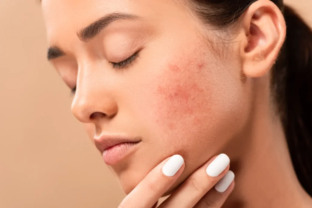 Close-up of a woman touching her jaw with red marks and uneven texture visible across her cheek.