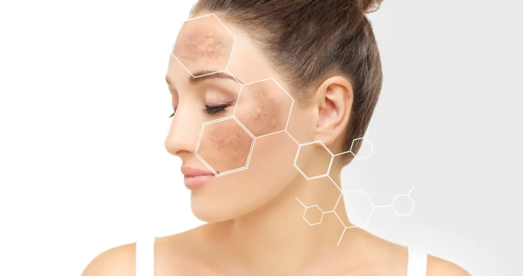 Side profile of a woman with brown facial patches highlighted by white geometric outlines.