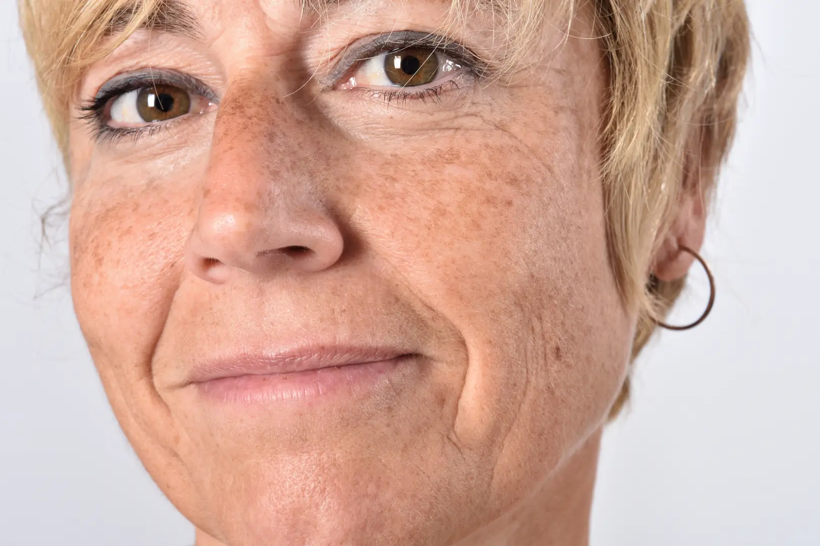 Get Rid of Age Spots on Face: The CO2 Laser Approach